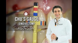 Chus Gauge Gingivectomy [upl. by Eneleoj]