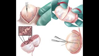 Βιοψία όρχεων με μικροσκόπιο  Μικροχειρουργική λήψη σπέρματος [upl. by Boothe]
