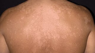 Tinea Versicolor [upl. by Menedez]