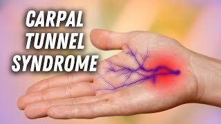 Carpal Tunnel Syndrome What It Is and Why It Happens [upl. by Theurer715]