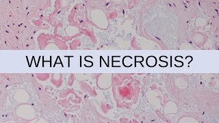 What is Necrosis  Pathology mini tutorial [upl. by Ybroc]