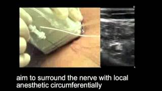 Popliteal Sciatic Nerve Block  Out of Plane Approach [upl. by Eimile]