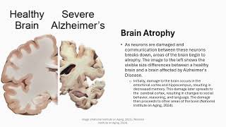 Pathophysiology Alzheimers Presentation [upl. by Norrehc]