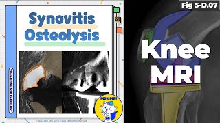 Fig 5D07 Polyethylene WearInduced Synovitis and Osteolysis [upl. by Anovad]