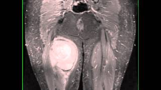 Synovial Sarcoma Thigh [upl. by Pattison24]