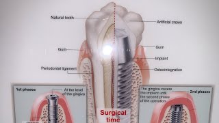 Get to know more about Dental Implants 🦷dentistry dentalimplants implants surgicaleducation [upl. by Ainessej]