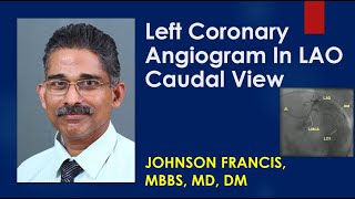 Left Coronary Angiogram In LAO Caudal View [upl. by Ecienaj927]