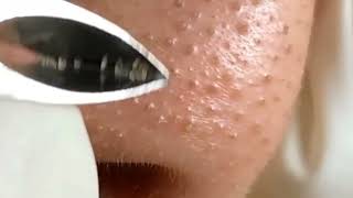 Acnes Treatment  how to remove small pimples from face and forehead  white pimples  blackheads [upl. by Suinotna775]