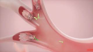 How It Works Zephyr Valve Treatment for COPD amp Emphysema [upl. by Jordan]