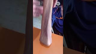 olecranon fracture physiotherapy exercise1 years full recovery olecranon [upl. by Zsazsa]