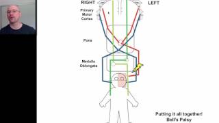 Hemiplegia 4 [upl. by Rafa274]