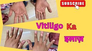 Vitiligo ka treatment Ke liye Gaya harshvlogs vlogs vitiligotreatment [upl. by Eduard]