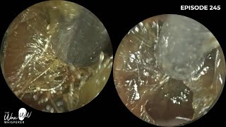 245  Dense Dark amp Sticky Ear Wax Removal using the WAXscope®️ [upl. by Hoashis587]