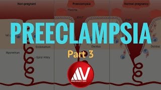 Preeclampsia Part III [upl. by Airotel]