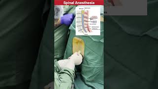 How spinal Anesthesia procedure is performed in Surgery doctor mbbs neet medical anesthesia [upl. by Namyh]