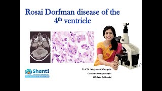 RosaiDorfman disease of the fourth ventricle [upl. by Linus]