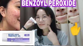 ACNEHINDI MO NA PROBLEM NGAYON ITO OILY SKIN BENZOYL PEROXIDEBENZAC EFFECTIVE TO [upl. by Nnylimaj]