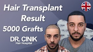 Hair Transplant Results with 5000 Grafts  Before and After  Dr Emrah Cinik [upl. by Ynohtna70]