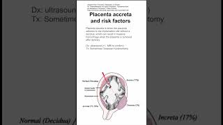 Placenta accreta and risk factors [upl. by Englis151]