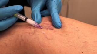 Spider Vein and Varicose Vein Treatment  Maryland Laser Skin amp Vein [upl. by Aleacem]