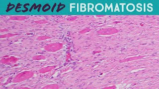 Desmoid Tumor Fibromatosis explained in 5 minutes pathology usmle FAP familial adenomatosis coli [upl. by Latrell922]