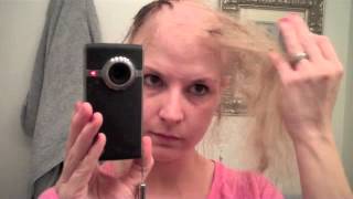 Road to balddom Last 5 days of Chemo hair loss Process [upl. by Akemrehs817]