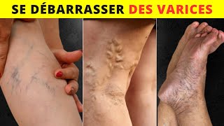 10 Façons Naturelles pour se Débarrasser des Varices et Augmenter le Flux Sanguin [upl. by Hathaway]