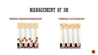 Dentinal Hypersensitivity [upl. by Elihu]