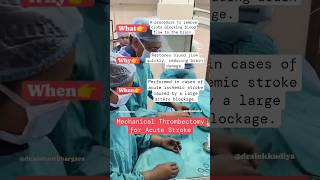 Mechanical Thrombectomy for acutestroke ytshorts interventionalneuroradiologist dralokkudiya [upl. by Garlen]