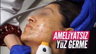 Ameliyatsız Yüz Germe  Thermage [upl. by Eralc]