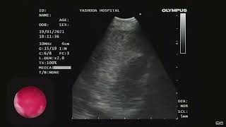 EBUS  Intranodal Cryobiopsy  Sarcoidosis [upl. by Agamemnon]