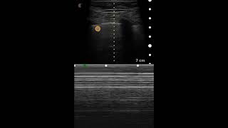 Pneumothorax Ultrasound Image Interpretation [upl. by Aseel]