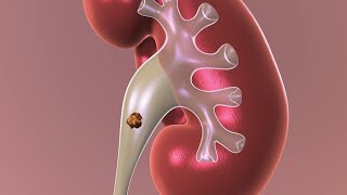 Observation Nonsurgical Approach to Kidney Stones [upl. by Ahsiek]