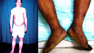 Myxedema Coma in 3 minutes Symptoms Causes Signs [upl. by Augusto50]