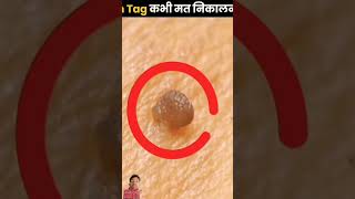 Skin tag removal knowledge interestingfacts amazing new thefact youtubeshorts trending [upl. by Thgiled12]