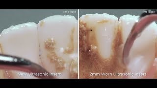 The impacts of ultrasonic insert tip wear  Dentsply Sirona [upl. by Flagler]