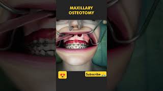 medical animationsurgery maxillary osteotomy❣️ [upl. by Laine314]