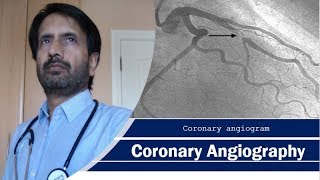 The Angiography Angiogram Procedure  How do doctors perform this procedure [upl. by Eerahc]