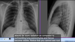 Differentiate Left and Right hemidiaphragms on chest xray lateral view [upl. by Babb773]