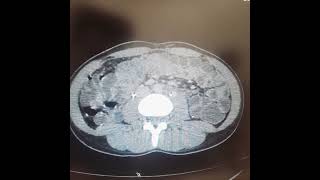 Ct Enterography with IV contrast [upl. by Nnyloj]