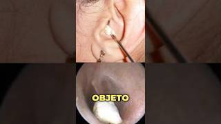 Haz esto si tienes un objeto extraño en el oído 👂 drwilsondelgado oido tipsdesalud [upl. by Iggep332]