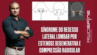 09112024  IL L5S1  SÍNDROME DO RECESSO LATERAL POR HÉRNIA DISCAL CALCIFICADA EM PACIENTE OBESO [upl. by Elleneg]