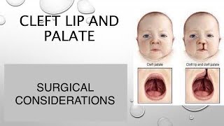 CLEFT LIP PALATESURGICAL CONSIDERATIONS dentabest4493 [upl. by Elehcim934]