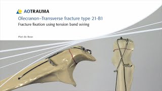 Olecranon  Fracture Fixation Using Tension Band Wiring [upl. by Altman]