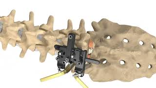 MAS TLIF  Patient Animation [upl. by Alsworth]