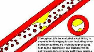 Atherosclerosis and Ischaemic Stroke [upl. by Ydnal493]