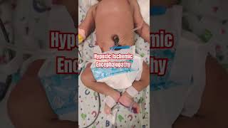 HypoxicIschemic Encephalopathy  what is HIE in newborn HIE seizures hypoxia [upl. by Nannah]