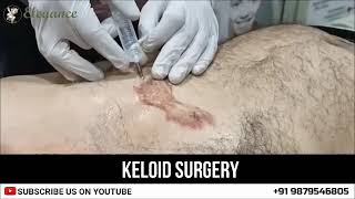 Treatment of keloid with Laser  Keloid Removal Surat by Dr Ashutosh Shah Elegance Clinic Gujarat [upl. by Arikehs]