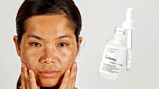 How To Use The Ordinary Alpha Arbutin 2  HA for Hyperpigmentation [upl. by Laurinda]