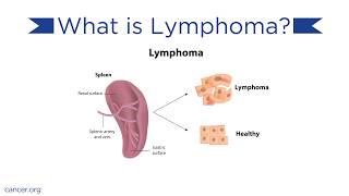 Lymphoma Causes and Treatments [upl. by Coveney]